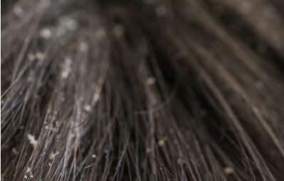 What Causes Dandruff in Dogs?